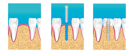 implants dentaires dentiste Mougins